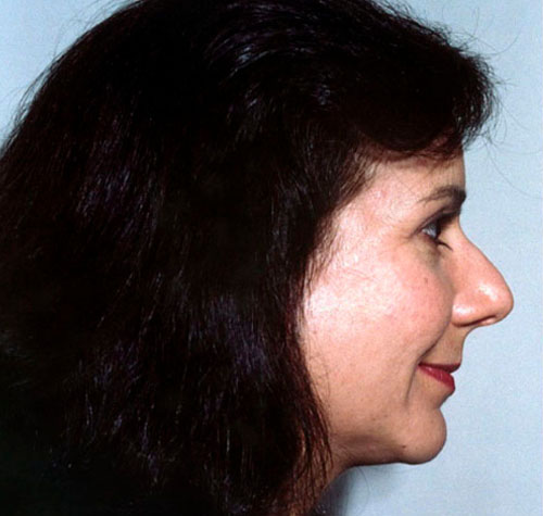 Rhinoplasty