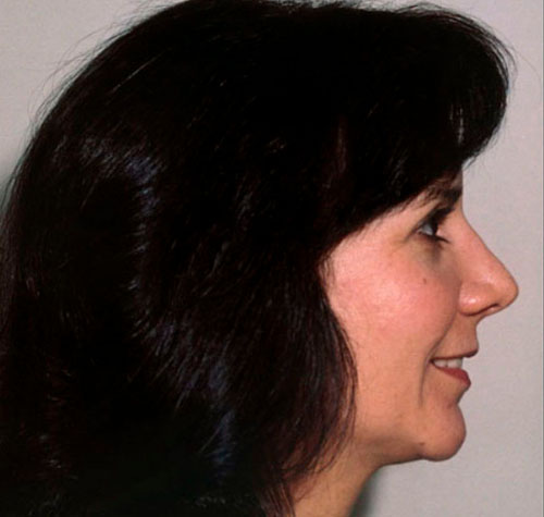 Rhinoplasty