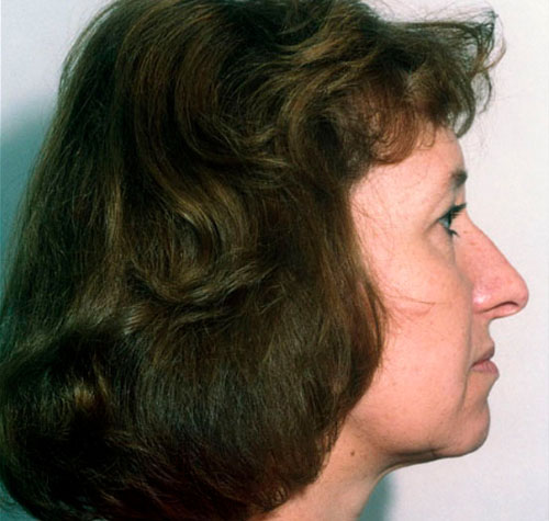 Rhinoplasty