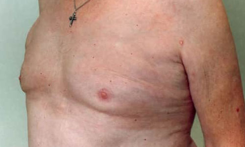 Male Liposuction