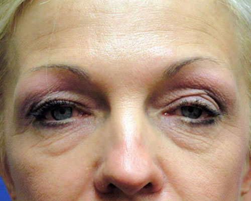 Eyelid Surgery