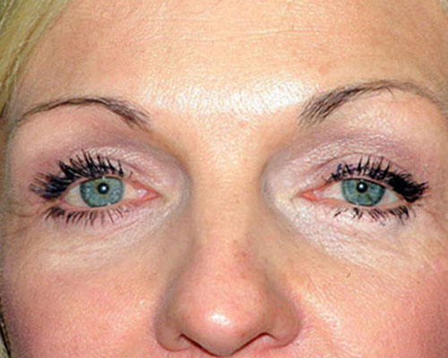 Eyelid Surgery