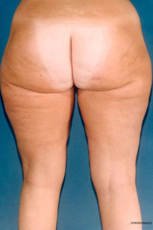 Liposuction - Body