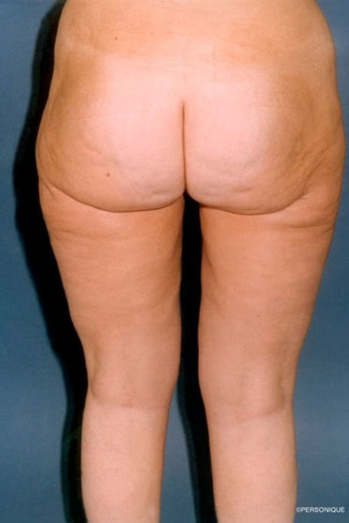 Liposuction - Body