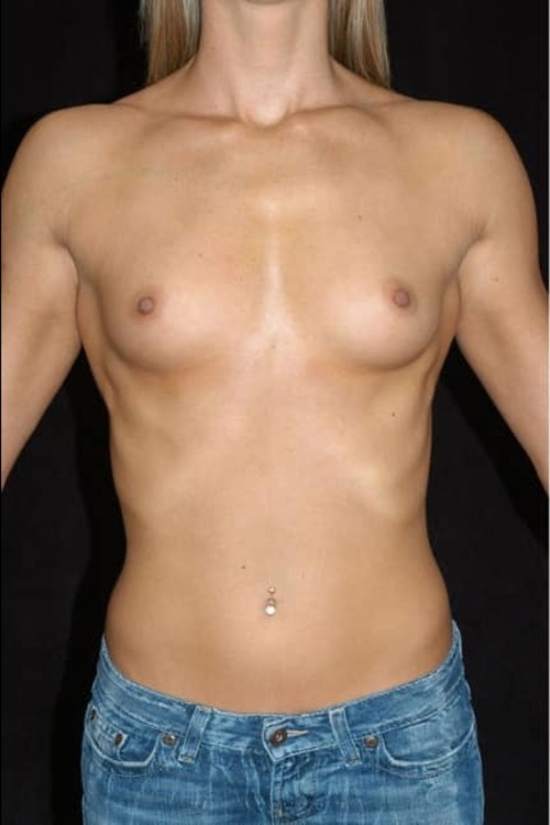 Breast Augmentation