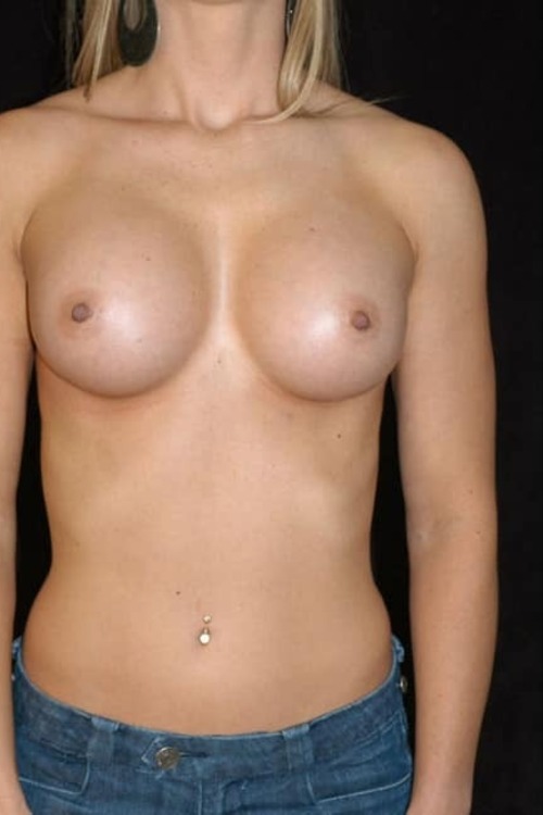 Breast Augmentation