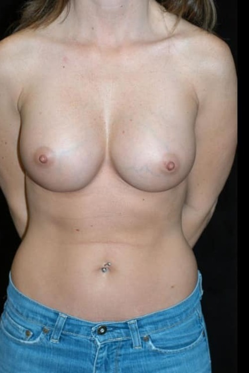 Breast Augmentation