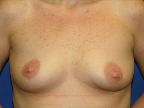 Breast Augmentation