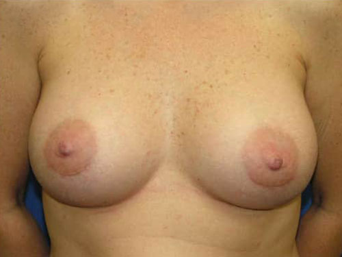 Breast Augmentation