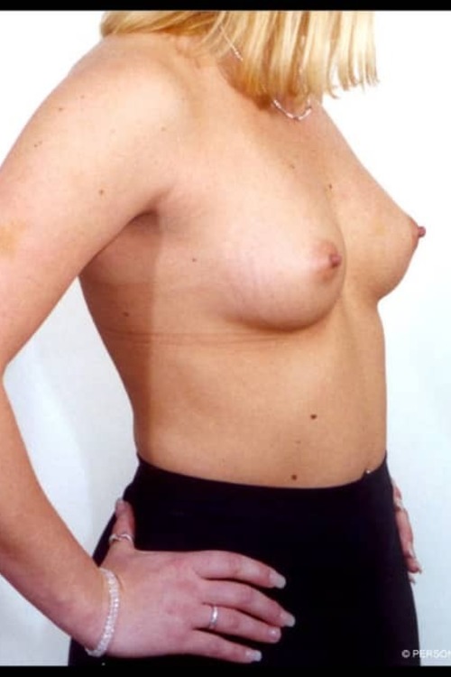 Breast Augmentation