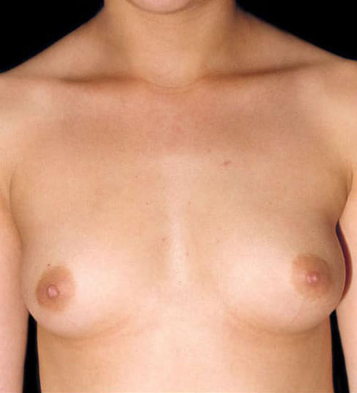 Breast Augmentation