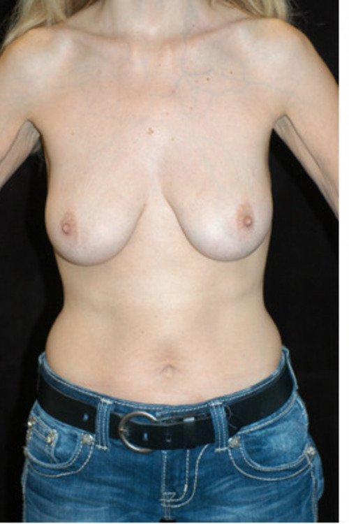 Breast Augmentation