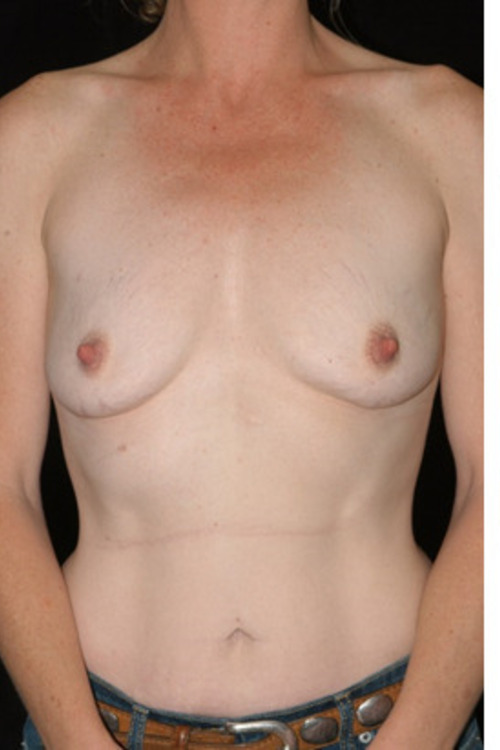 Breast Augmentation