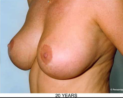 Breast Lift