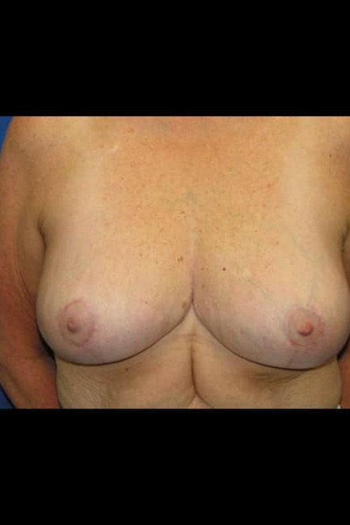 Breast Lift