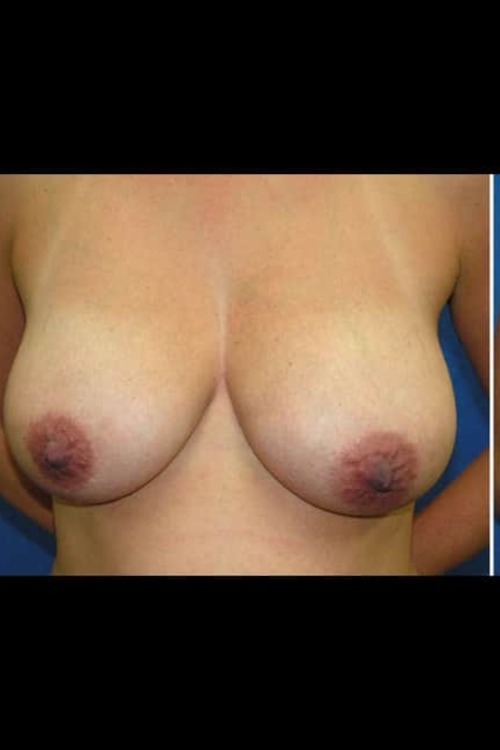 Breast Lift