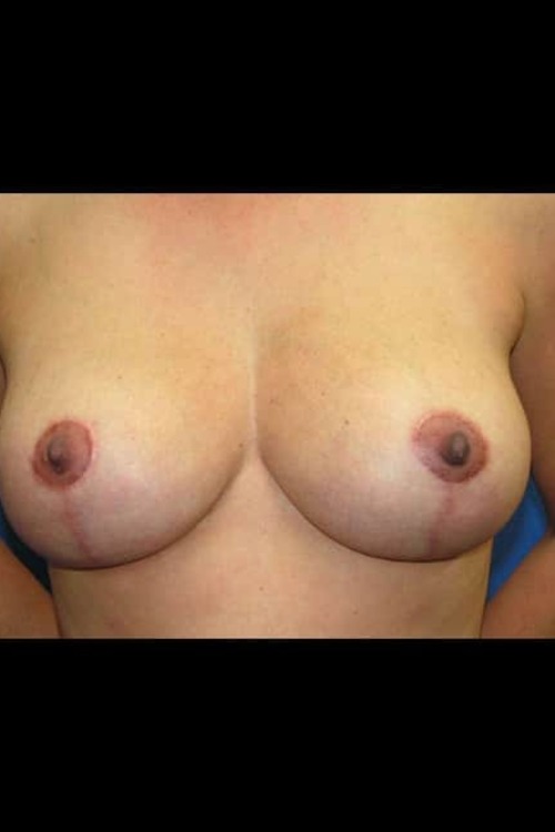 Breast Lift