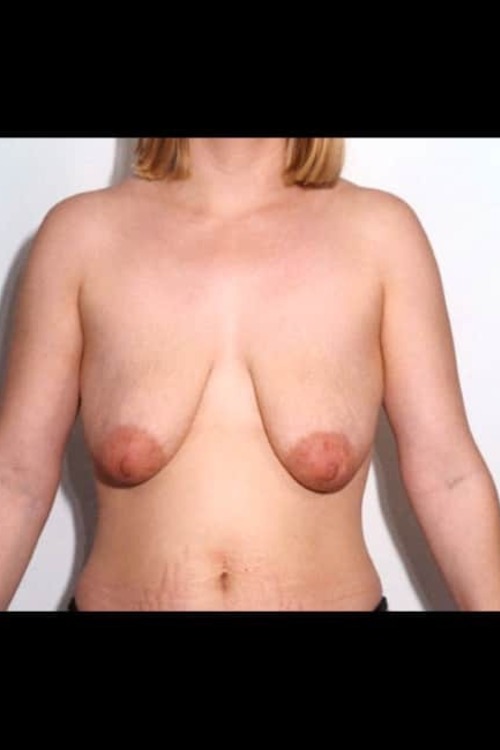 Breast Lift