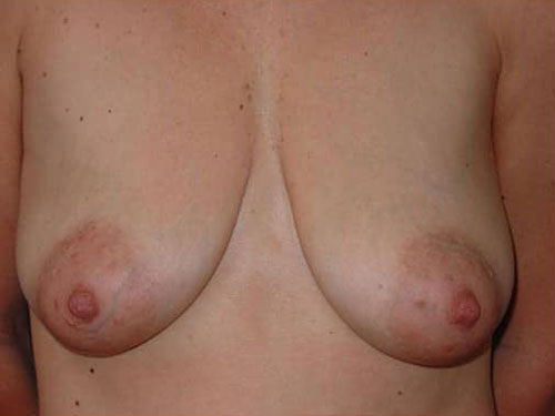 Breast Lift