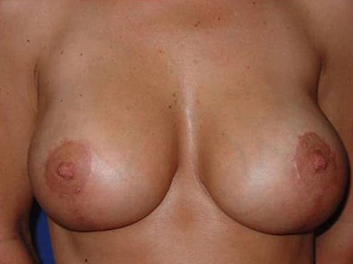 Breast Lift