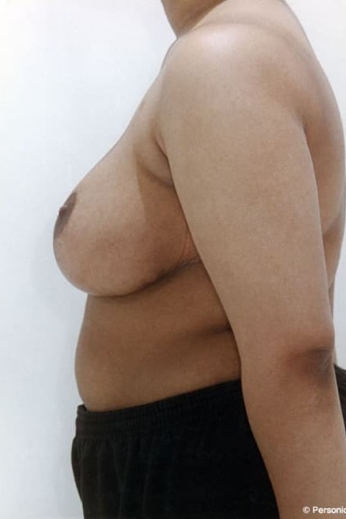 Breast Reduction