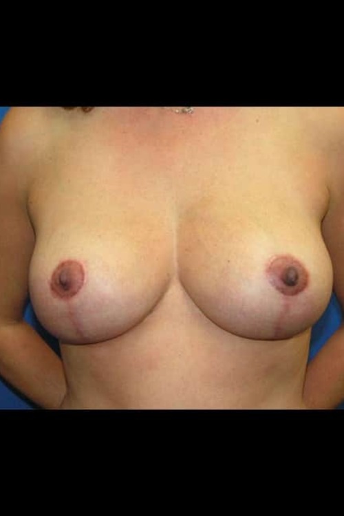 Breast Reduction