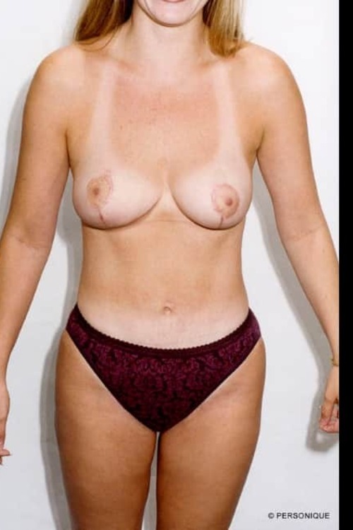 Breast Reduction