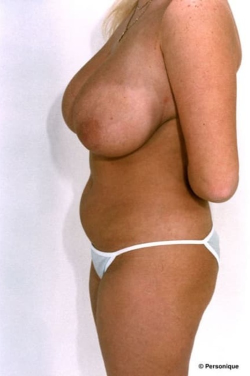 Breast Reduction