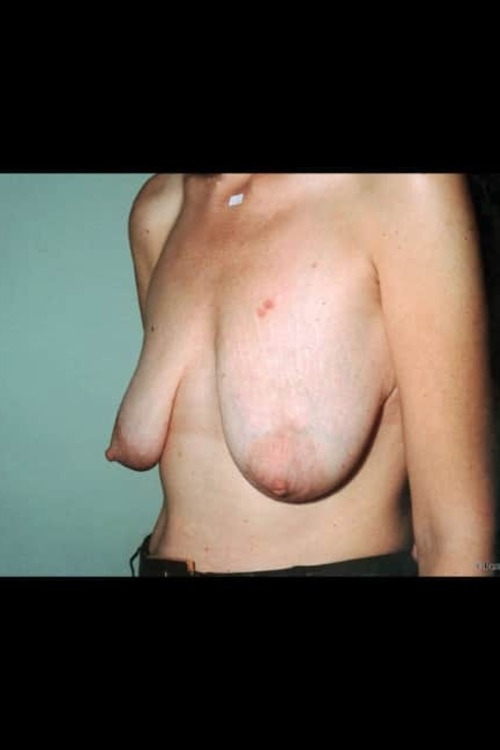 Breast Reduction