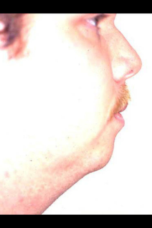 Chin Augmentation