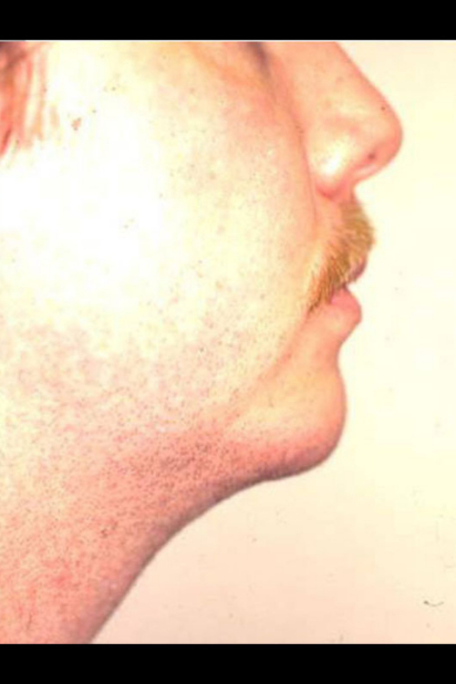 Chin Augmentation