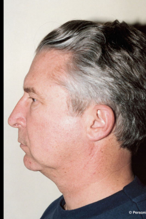 Chin Augmentation