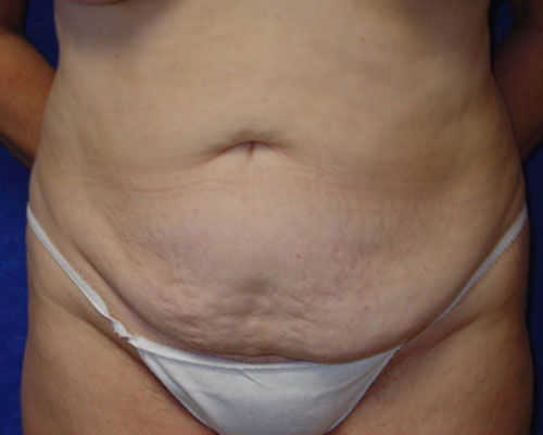 Circumferential Tummy Tuck