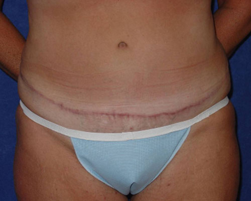 Circumferential Tummy Tuck