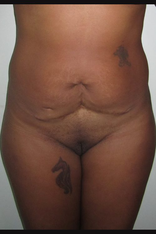 Circumferential Tummy Tuck