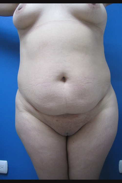 Circumferential Tummy Tuck