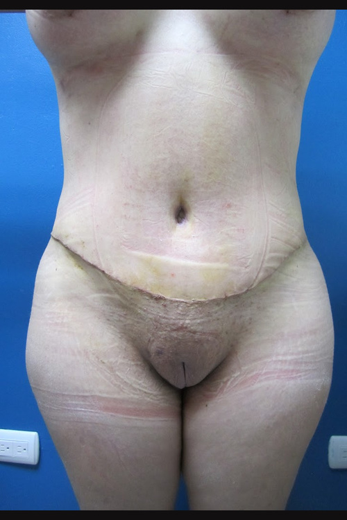 Circumferential Tummy Tuck