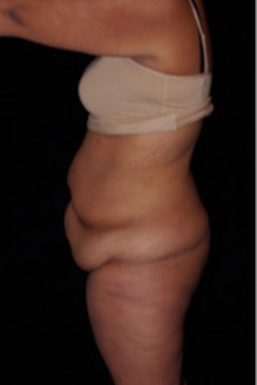 Circumferential Tummy Tuck