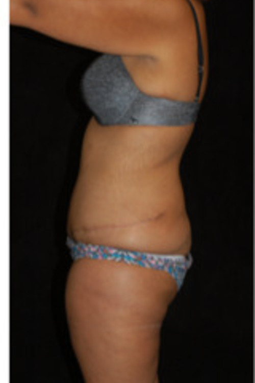 Circumferential Tummy Tuck