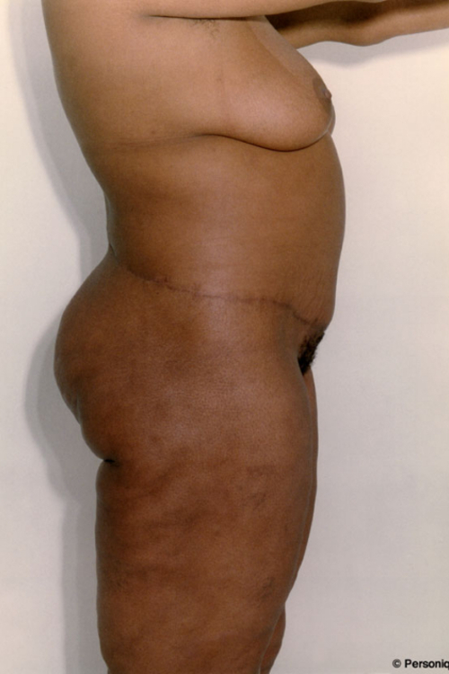 Circumferential Tummy Tuck