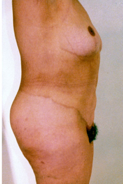 Circumferential Tummy Tuck