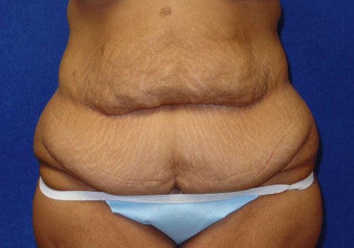 Circumferential Tummy Tuck