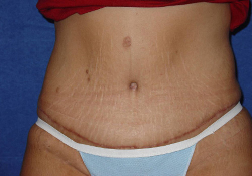 Circumferential Tummy Tuck