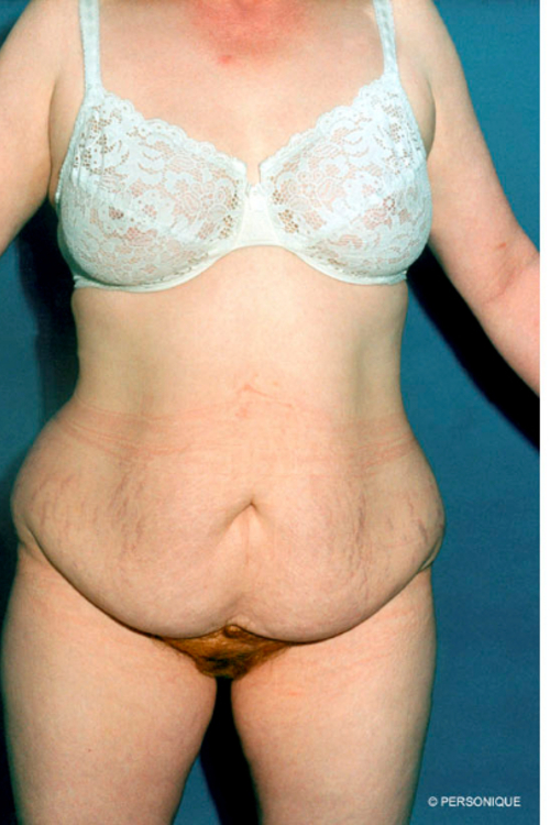 Circumferential Tummy Tuck