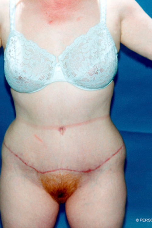 Circumferential Tummy Tuck