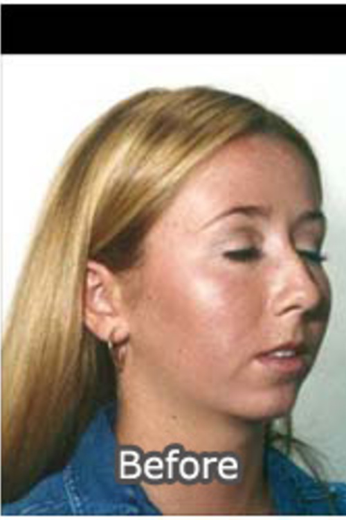 Chemical Peel