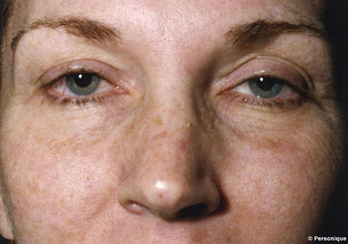 Eyelid Surgery