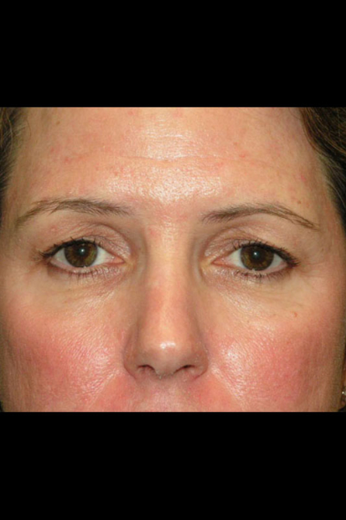 Eyelid Surgery