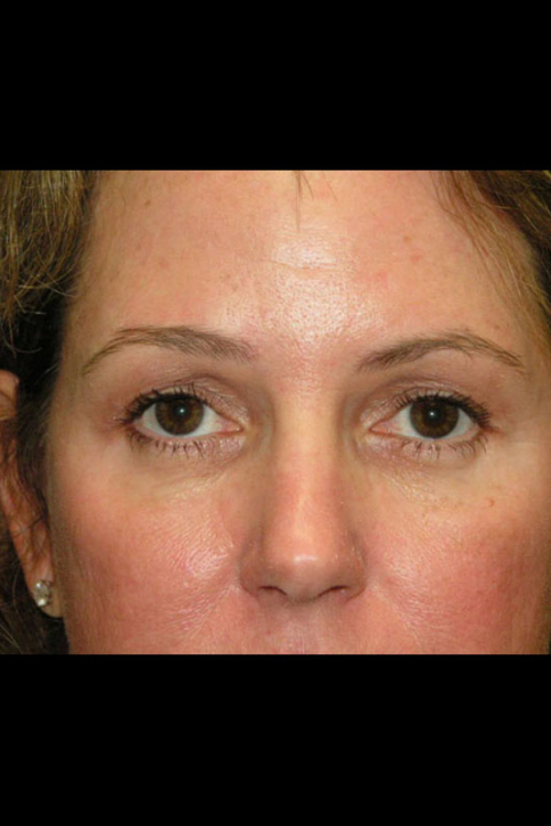 Eyelid Surgery