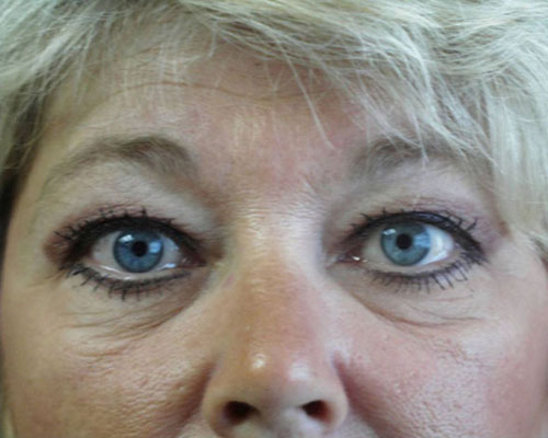 Eyelid Surgery